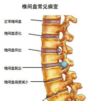 椎间.jpg