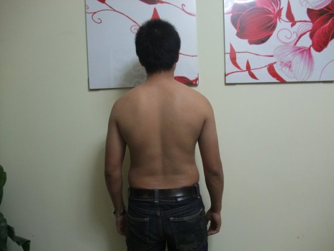 减肥前背部照，2011年3月84KG
